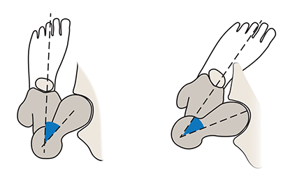 Femoral Anteversion