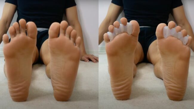 A person's feet, with the photo on the right showing toe spacers being used.